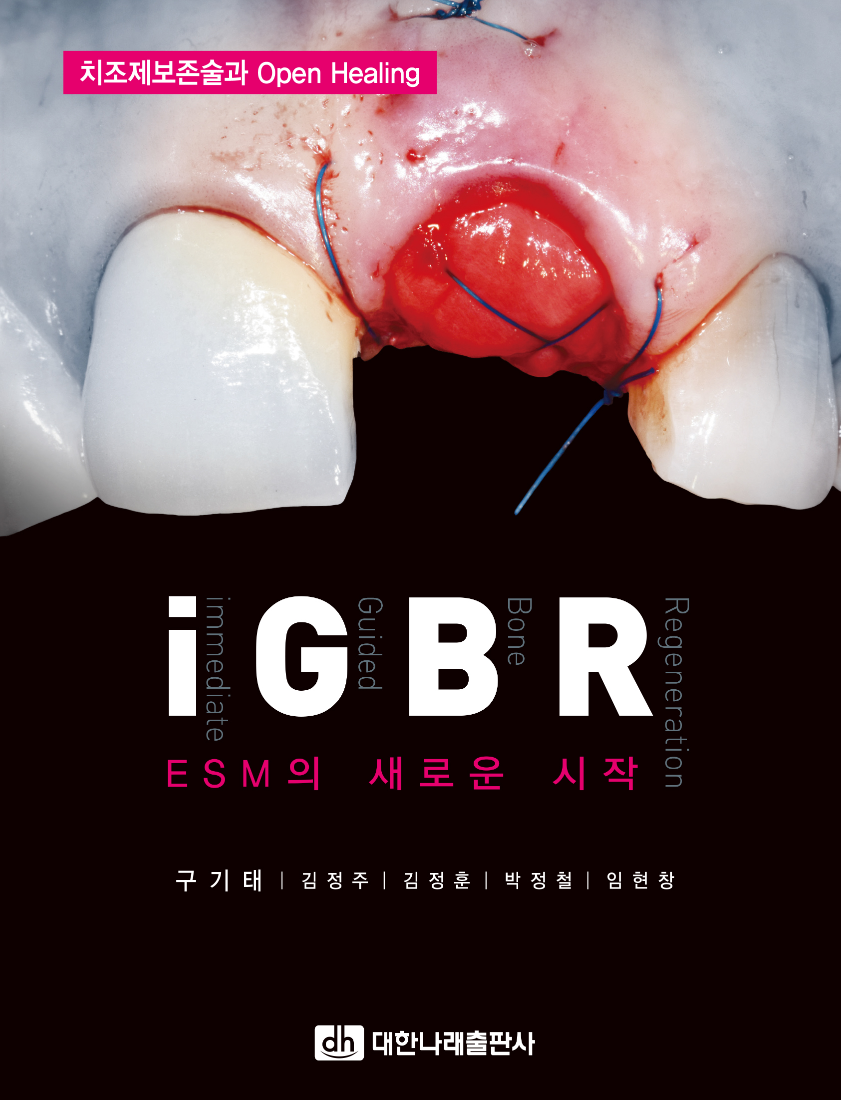 iGBR: ESM의 새로운 시작